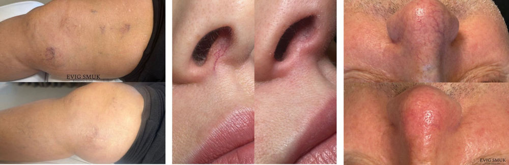karsprængninger-behandling-ipl-laser-vejle-kosmetisk-sygeplejerske